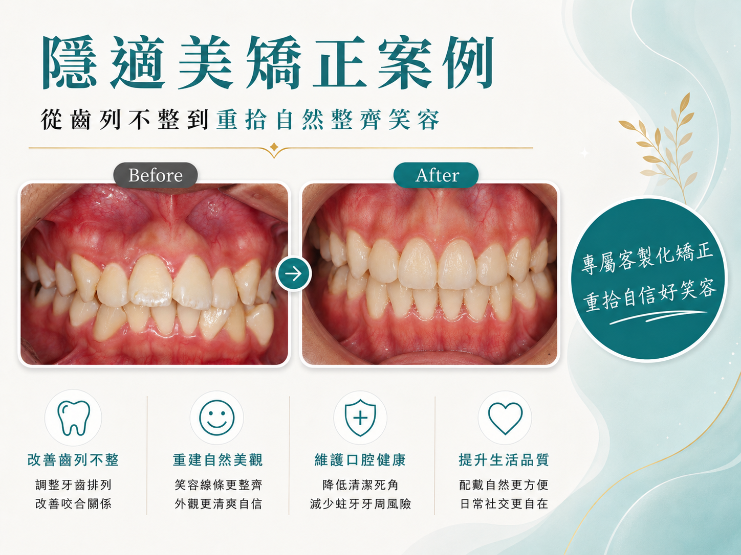 改變的不只是齒列，而是笑起來更自在的自己Ｘ 隱適美矯正案例